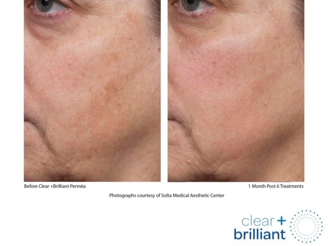 Clear + Brilliant Before and After