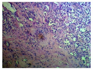 Clear cell variant of renal cell acrcinoma Slide 11