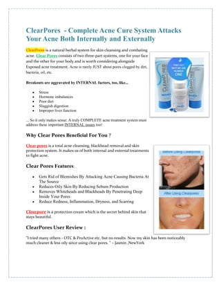ClearPores  - Complete Acne Cure System Attacks Your Acne Both Internally and 4448175727075Externally<br />ClearPores is a natural herbal system for skin cleansing and combating acne. Clear Pores consists of two three-part systems, one for your face and the other for your body and is worth considering alongside Exposed acne treatment. Acne is rarely JUST about pores clogged by dirt, bacteria, oil, etc.<br />Breakouts are aggravated by INTERNAL factors, too, like...<br />Stress<br />Hormone imbalances<br />Poor diet<br />Sluggish digestion <br />Improper liver function<br />... So it only makes sense: A truly COMPLETE acne treatment system must address these important INTERNAL issues too!<br />Why Clear Pores Beneficial For You ?<br />Clear pores is a total acne cleansing, blackhead removal and 4591050176530skin protection system. It makes us of both internal and external treatments to fight acne. <br />Clear Pores Features:<br />Gets Rid of Blemishes By Attacking Acne Causing Bacteria At The Source<br />Reduces Oily Skin By Reducing Sebum Production<br />Removes Whiteheads and Blackheads By Penetrating Deep Inside Your Pores<br />Reduce Redness, Inflammation, Dryness, and Scarring<br />Clearpore is a protection cream which is the secret behind skin that stays beautiful.<br />ClearPores User Review :<br />quot;
I tried many others - OTC & ProActive etc. but no results. Now my skin has been noticeably much cleaner & less oily since using clear pores. quot;
 – Jasmin ,NewYork <br />