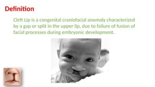cleft lip.A medical student presentation | PPTX