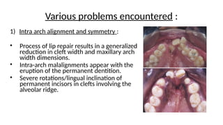 Management of Cleft Lip and Palate - Orthodontics | PPTX
