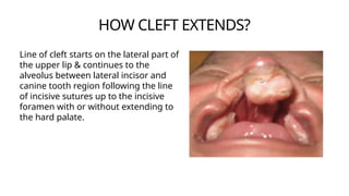 Management of Cleft Lip and Palate - Orthodontics | PPTX