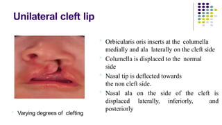 Mitmidsr-cleft-lip-and-palate-final.pptx