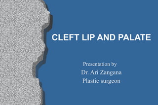CLEFT LIP AND PALATE Presentation by  Dr. Ari Zangana Plastic surgeon 