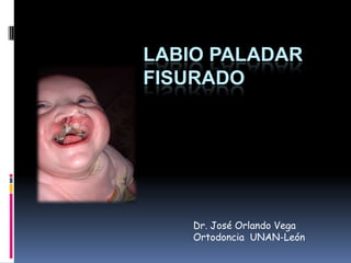 LABIO PALADAR
FISURADO
Dr. José Orlando Vega
Ortodoncia UNAN-León
 