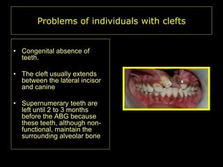 Problems of individuals with clefts
• Congenital absence of
teeth.
• The cleft usually extends
between the lateral incisor
and canine
• Supernumerary teeth are
left until 2 to 3 months
before the ABG because
these teeth, although nonfunctional, maintain the
surrounding alveolar bone

 