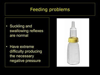 Feeding problems

• Suckling and
swallowing reflexes
are normal
• Have extreme
difficulty producing
the necessary
negative pressure

 