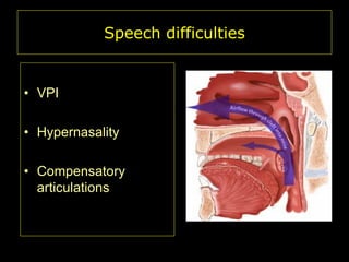 Speech difficulties

• VPI
• Hypernasality
• Compensatory
articulations

 