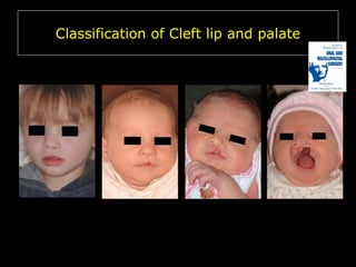 Classification of Cleft lip and palate

 