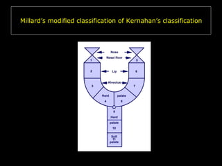 Millard’s modified classification of Kernahan’s classification

 