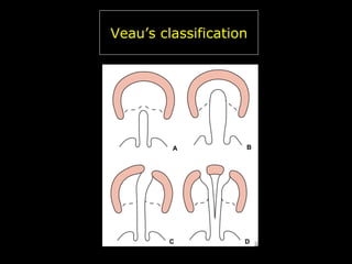 Veau’s classification

 
