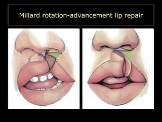 Millard rotation-advancement lip repair

 