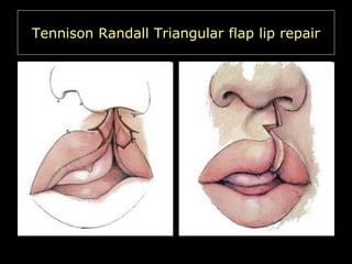 Tennison Randall Triangular flap lip repair

 