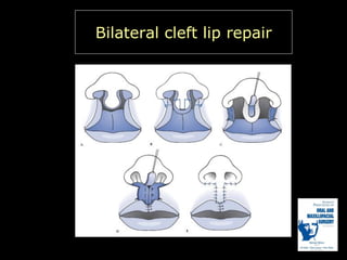 Bilateral cleft lip repair

 