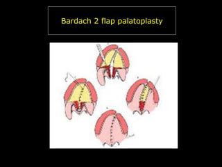Bardach 2 flap palatoplasty

 