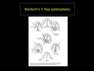 Bardach’s 2 flap palatoplasty

 