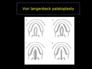 Von langenbeck palatoplasty

 