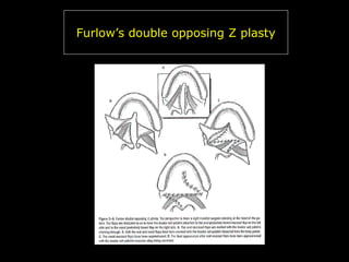 Furlow’s double opposing Z plasty

 