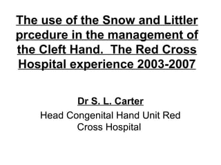 The use of the Snow and Littler 
prcedure in the management of 
the Cleft Hand. The Red Cross 
Hospital experience 2003-2007 
Dr S. L. Carter 
Head Congenital Hand Unit Red 
Cross Hospital 
 