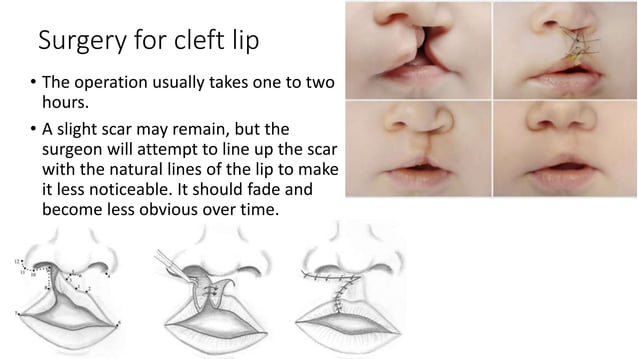 Cleft lip and palate from embryological development till maturity. | PPTX