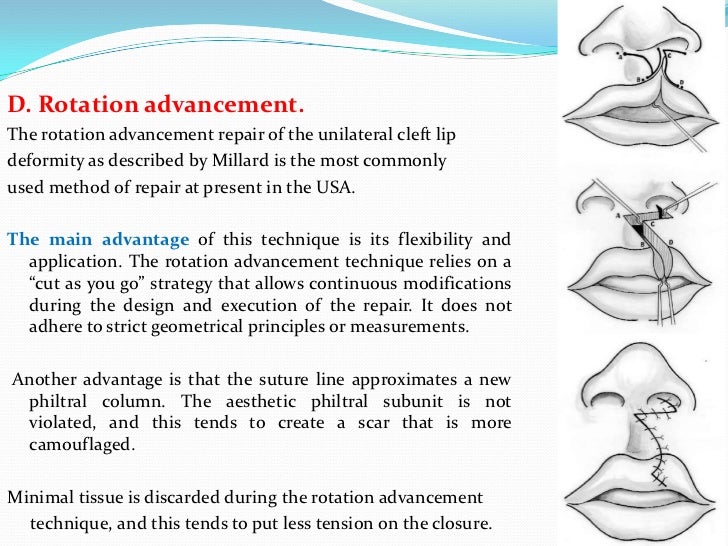 bilateral cleft lip