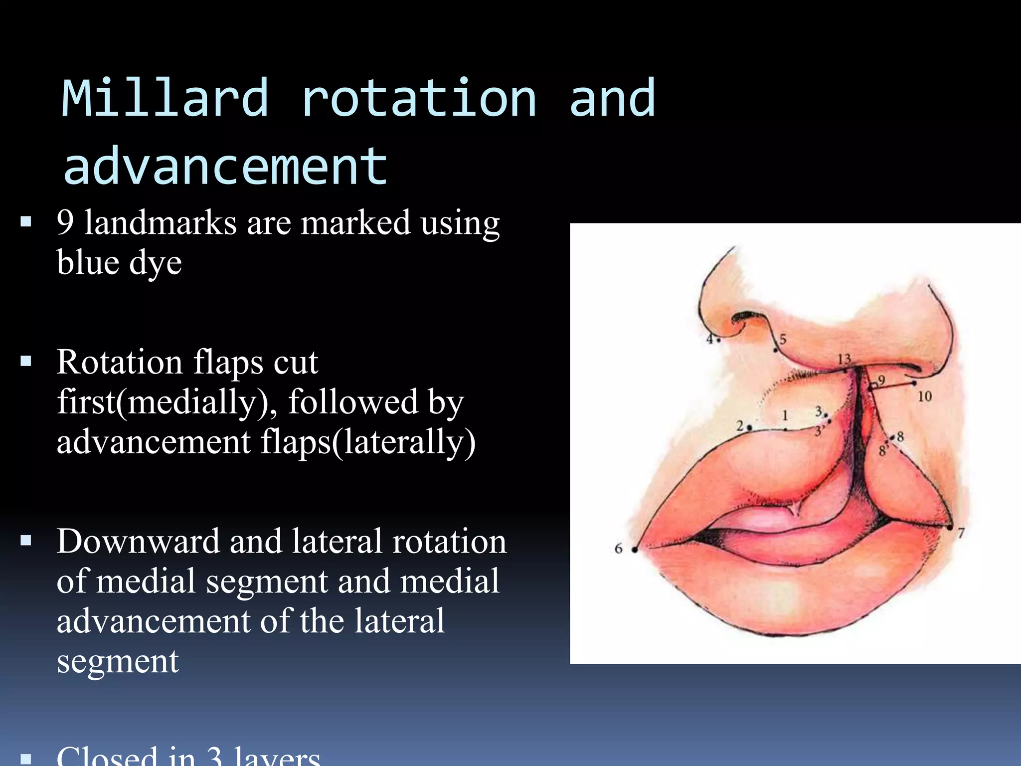 Cleft lip and Cleft palate embryology, features, and management | PPTX