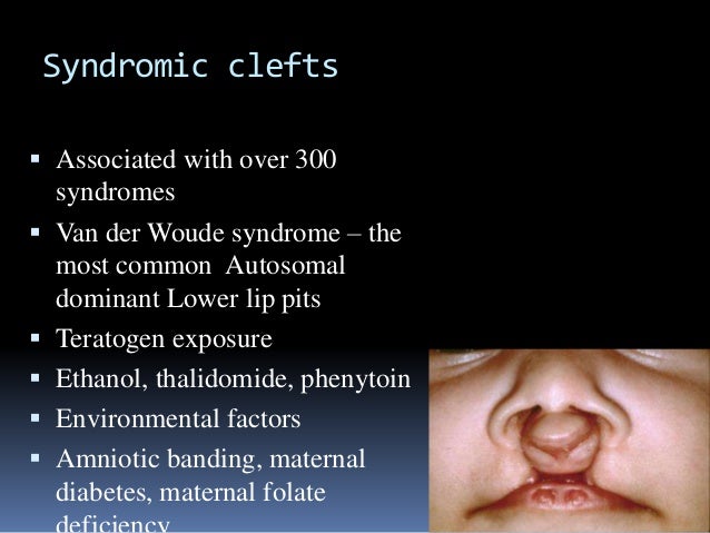 Cleft lip and Cleft palate embryology, features, and management