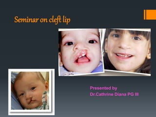 Seminar on cleft lip
Presented by
Dr.Cathrine Diana PG III
 