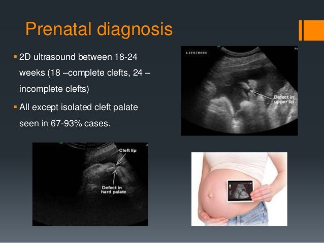 etico - ¿Sería etico pagar a las madres para que aborten fetos con cromosomas defectuosos? Cleft-lip-23-638