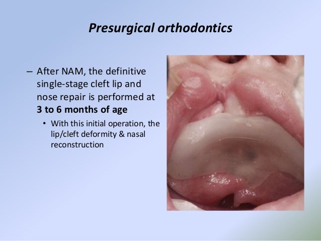 cleft lip repair