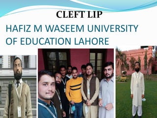 CLEFT LIP
HAFIZ M WASEEM UNIVERSITY
OF EDUCATION LAHORE
 