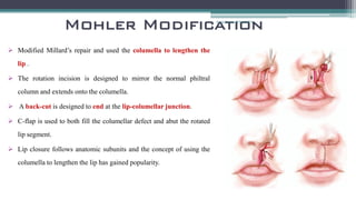 Cleft lip | PDF