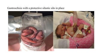 Gastroschisis with a protective silastic silo in place
 