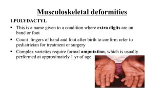 Musculoskeletal deformities
1.POLYDACTYL
 This is a name given to a condition where extra digits are on
hand or foot
 Count fingers of hand and foot after birth to confirm refer to
pediatrician for treatment or surgery
 Complex varieties require formal amputation, which is usually
performed at approximately 1 yr of age.
 