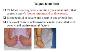 Talipes (club foot)
 Clubfoot is a congenital condition (present at birth) that
causes a baby’s foot to turn inward or downward.
 It can be mild or severe and occur in one or both feet.
 The exact cause is unknown but can be associated with
genetic and environmental factors
 