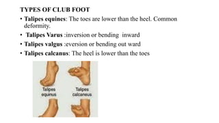 TYPES OF CLUB FOOT
• Talipes equines: The toes are lower than the heel. Common
deformity.
• Talipes Varus :inversion or bending inward
• Talipes valgus :eversion or bending out ward
• Talipes calcanus: The heel is lower than the toes
 