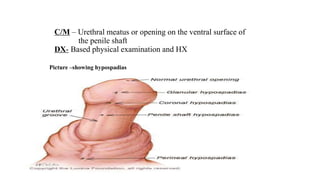 C/M – Urethral meatus or opening on the ventral surface of
the penile shaft
DX- Based physical examination and HX
Picture –showing hypospadias
 