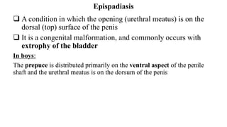 Epispadiasis
 A condition in which the opening (urethral meatus) is on the
dorsal (top) surface of the penis
 It is a congenital malformation, and commonly occurs with
extrophy of the bladder
In boys:
The prepuce is distributed primarily on the ventral aspect of the penile
shaft and the urethral meatus is on the dorsum of the penis
 