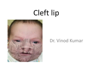 Cleft lip
Dr. Vinod Kumar
 