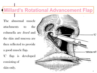 cleft lip and palate and its management.pptx