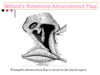 cleft lip and palate and its management.pptx