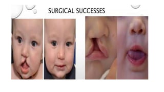 Comprehensive Overview of Cleft Lip and Palate: Embryology ...