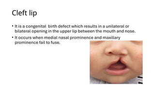Comprehensive Overview of Cleft Lip and Palate: Embryology ...