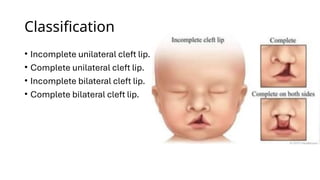 Systemic Cleft Comprehensive Overview of Cleft Lip and Palate: Embryology ...