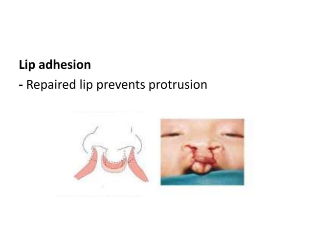 Cleft lip bilateral | PPTX