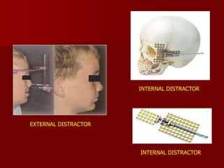 Internal Distractor Cleft Lip & Palate | PPT
