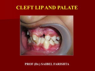 CLEFT LIPAND PALATE
PROF (Dr.) SAIBEL FARISHTA
 