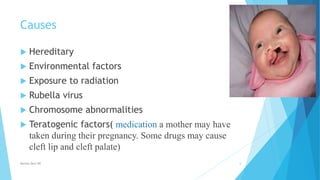 Causes
 Hereditary
 Environmental factors
 Exposure to radiation
 Rubella virus
 Chromosome abnormalities
 Teratogenic factors( medication a mother may have
taken during their pregnancy. Some drugs may cause
cleft lip and cleft palate)
Monika Devi NR 6
 