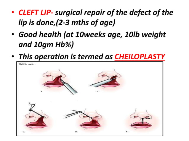 Cleft lip and cleft palate | PPTX | Ear, Nose and Throat Conditions ...