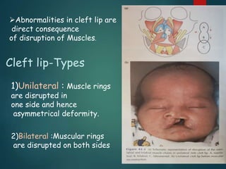 Cleft lip and cleft palate | PPTX